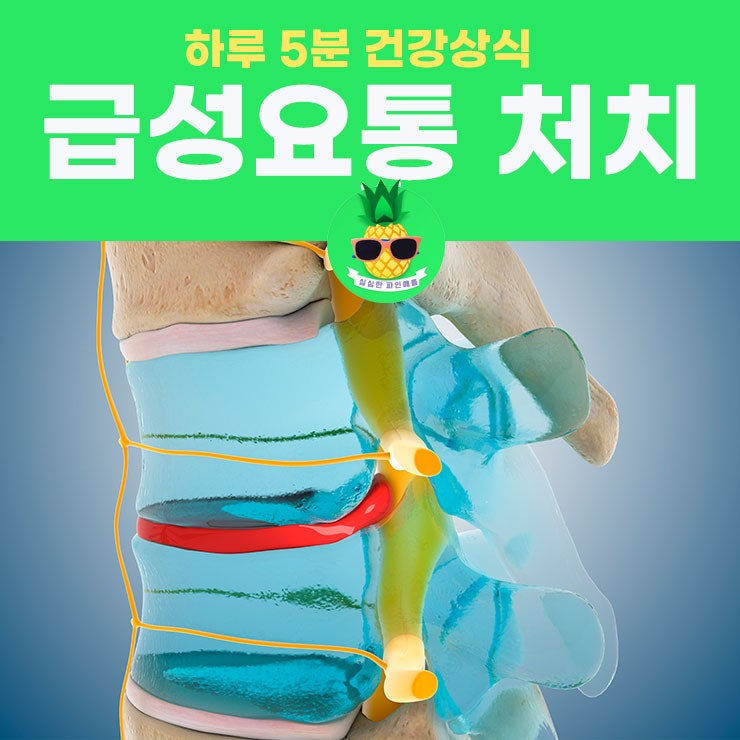 급성 요통(허리디스크) 원인, 증상, 응급처치, 회복시간, 약국약 VS 병원약