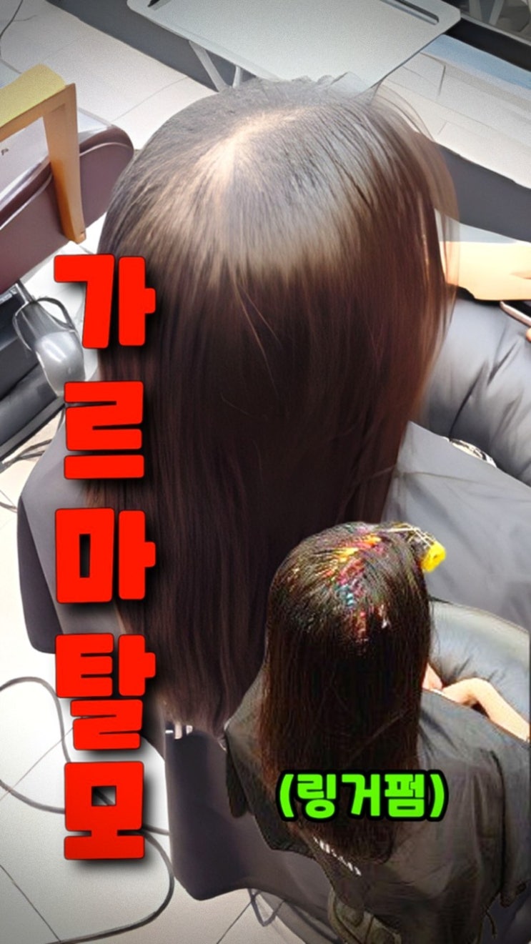  서울 왕십리 가르마탈모 해결! 수원 율전동 아엠헤드 링거펌 리얼 후기