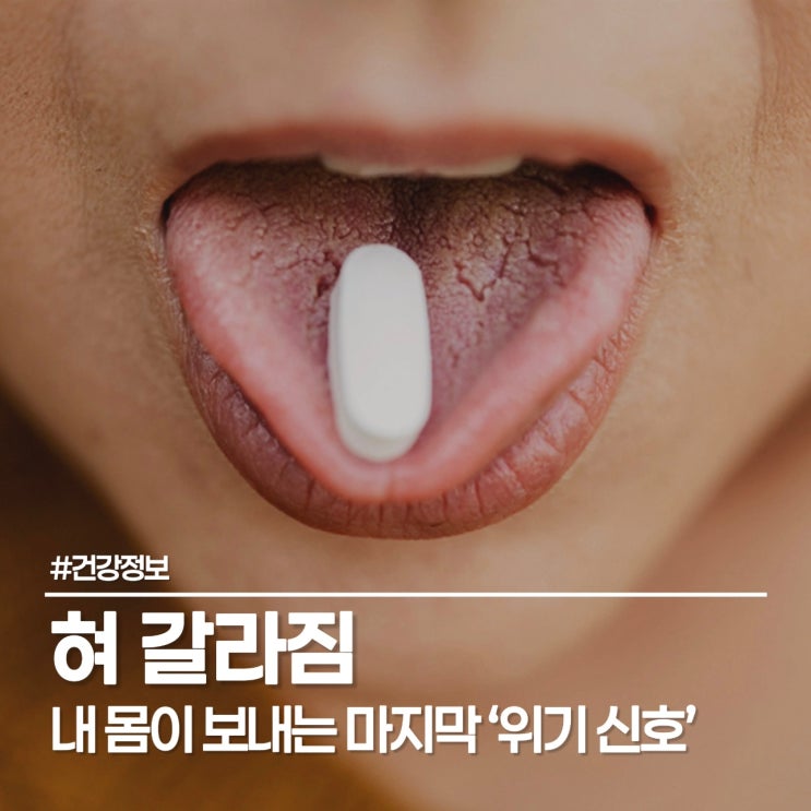  거울 속 내 혀가 보내는 건강 신호? 혀 갈라짐 원인부터 관리법까지
