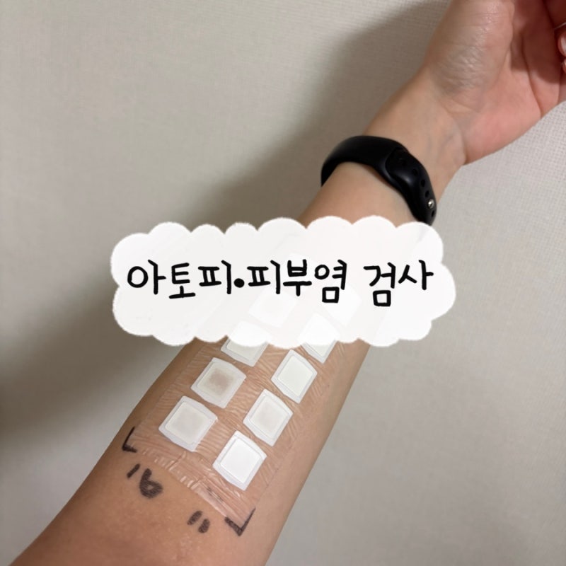 미라젠 의원 | 아토피 검사 안내 (TEWL 측정, MAST, 첩포검사)