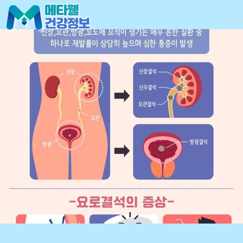 옆구리가 찢어지는 통증, 요로결석 초기증상과 원인, 제거 방법까지