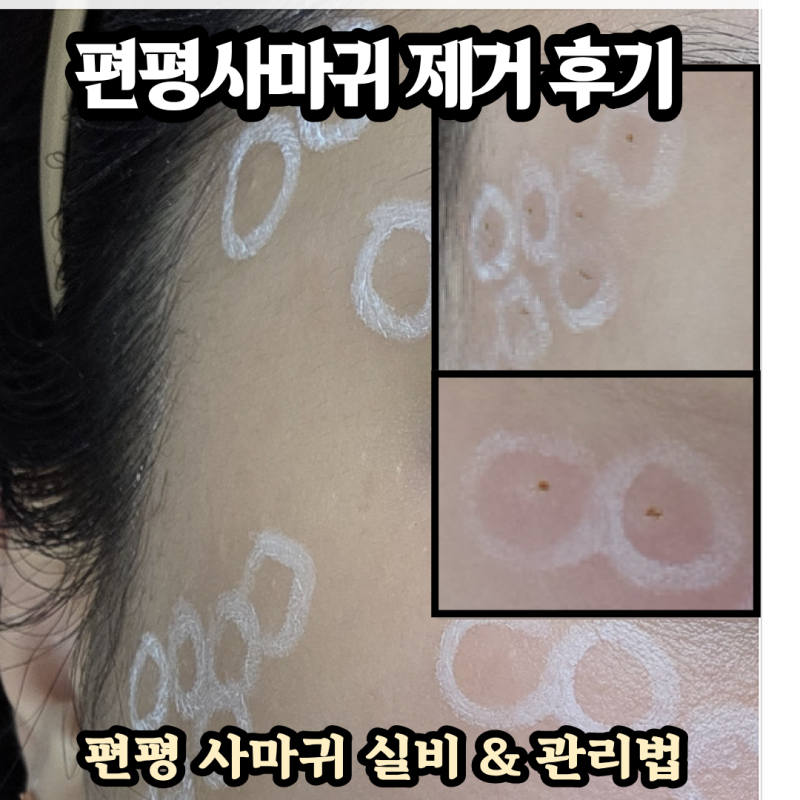내돈내산 편평사마귀 레이저 제거 후기 / 실비 보험 청구부터 관리까지 완벽 정리