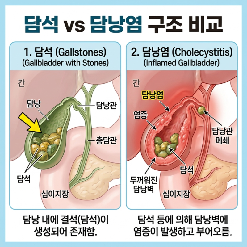 담석 vs 담낭염 차이 완벽 정리! 증상,원인,치료 한눈에 (초기증상부터 병원 가야 할 때까지)