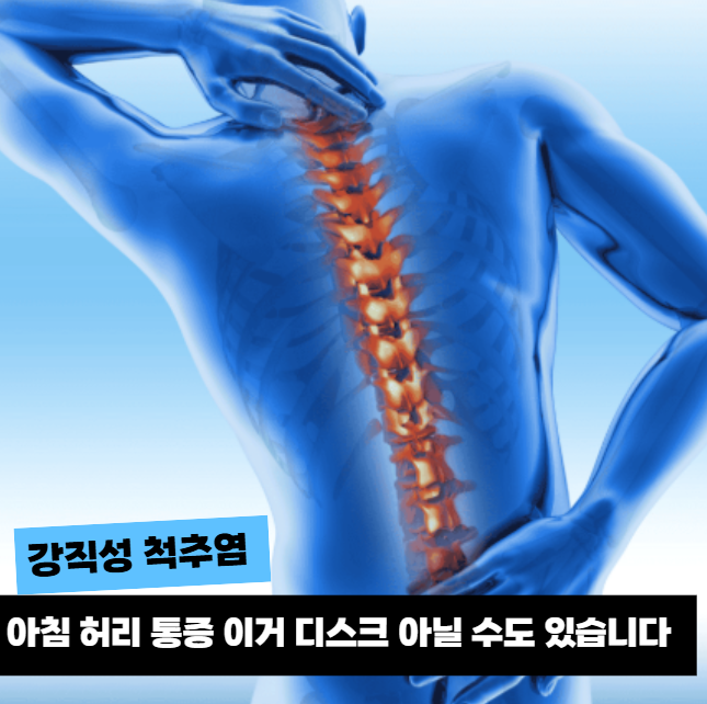아침마다 뻣뻣했던 원인 따로 있었습니다... 강직성 척추염 검사 다들 놓치는 "이 차이"