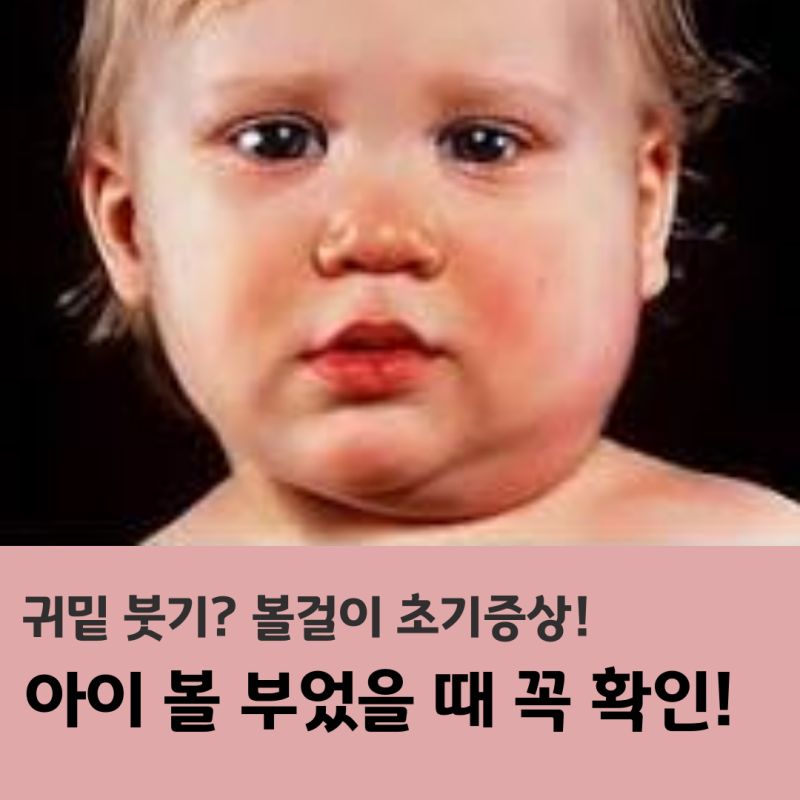 유행성이하선염 초기 증상, 귀밑이 붓고 아프면 꼭 확인!