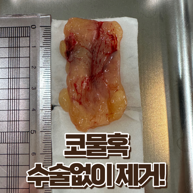  코물혹, 수술 없이 한의원에서 제거할 수 있을까요?