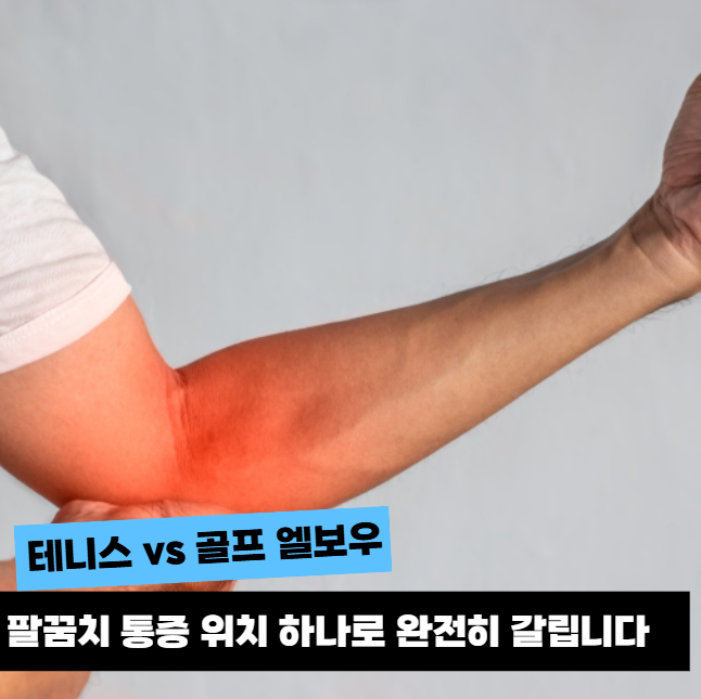 팔꿈치 통증 헷갈리셨죠? 테니스 엘보우 vs 골프 엘보우 "이 차이"에서 갈립니다