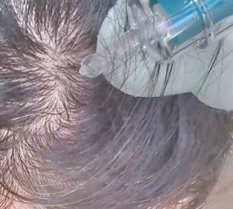 현대약품 마이녹셀 탈모앰플 효과 후기, PDRN 스피큘 두피 변화 직접 써봄