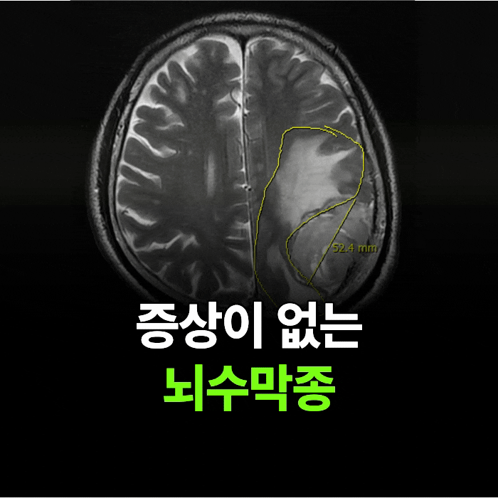 뇌 MRA란? 결과로 뭘 알수 있을까? (수원 건강검진 센터)