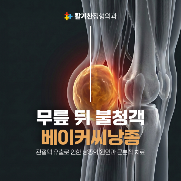  구파발정형외과, 무릎 뒤쪽 물혹 베이커 낭종 생기는 원인