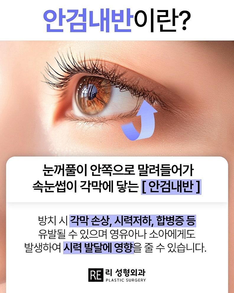 안검내반 수술 비용 들여가면서 왜 해야 할까?