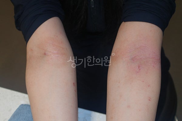아토피에 좋은 약초, 무작정 찾기보다 내 피부 상태부터 살펴야 합니다