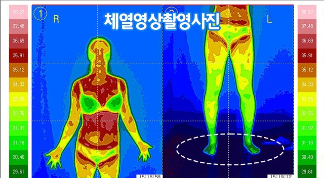 수족냉증(Raynaud 현상) - 원인 찾았다!!