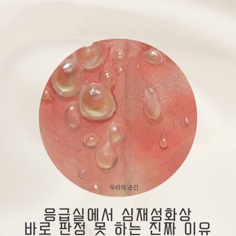 화상 심재성 표재성 차이, 응급실에서 바로 판정 못 하는 진짜 이유