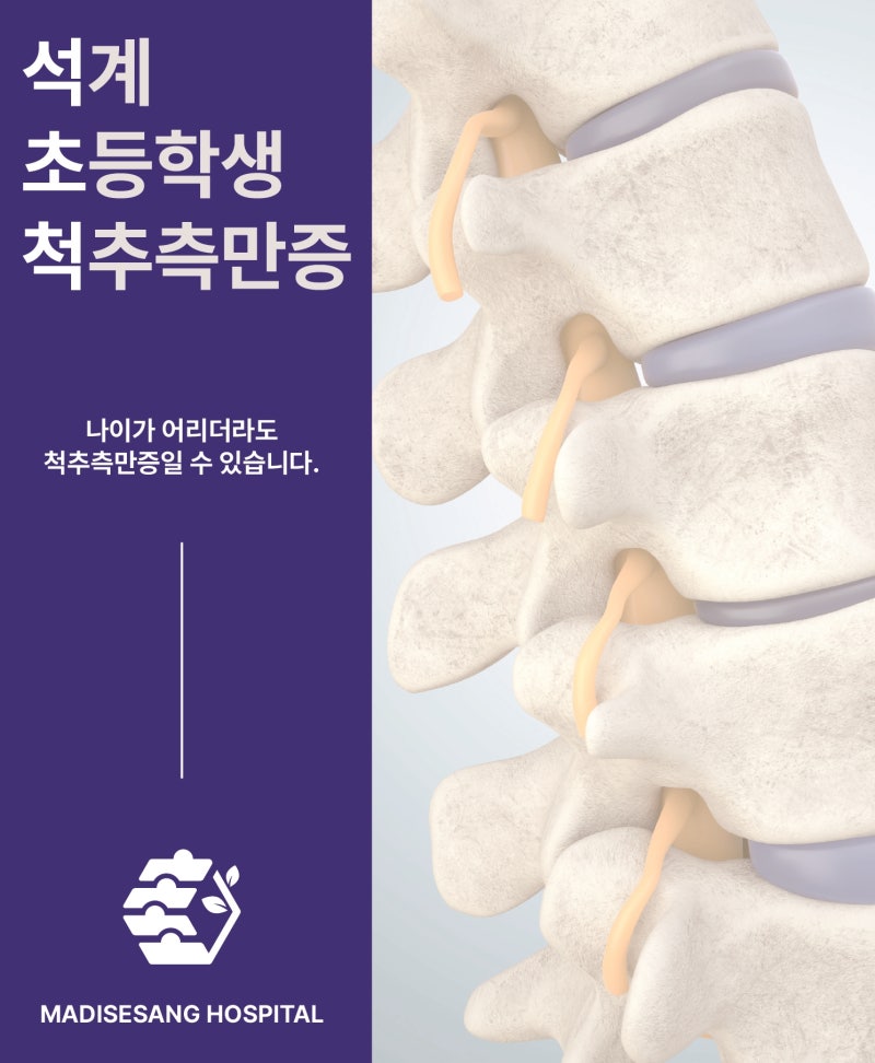 석계 학생 척추측만증 증상과 치료 시기는