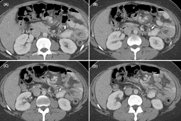 Case Review_156-복부 통증을 호소하는 48세 여성- Jejunojejunal intussusception(공장중첩증)