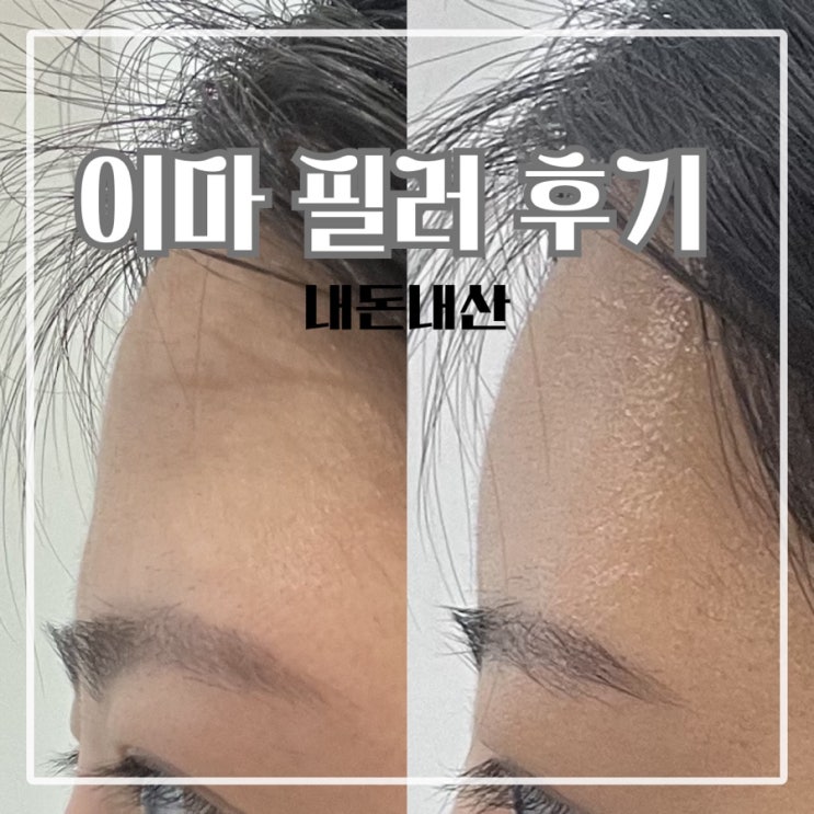  이마 필러 후기 7cc 내돈내산 후기 12일 동안 통증·붓기·만족도 기록