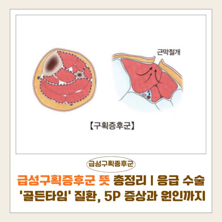  급성구획증후군 뜻 총정리 | 응급 수술 ‘골든타임’ 질환, 5P 증상과 원인까지