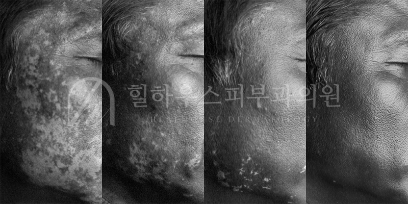 백반증 엑시머 치료, 저용량 vs 고용량 어떤 게 유리할까?