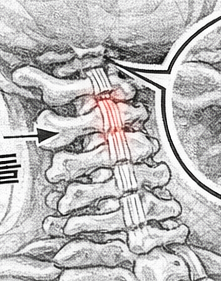 갑자기 목이 안 돌아간다면 경추 인대 염좌, 단순 담이 아닐 수 있습니다