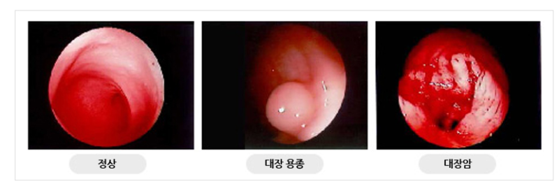 용종? 선종? 뭔 차이잉니데? 유사암진단비는 이 진단일때만 | 용종·선종·제자리암 진단코드 ....