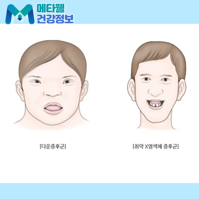 "지적장애는 유전인가요?" 지적장애의 특징, 원인, 2급 3급 등급 기준까지 바르게 이해하기