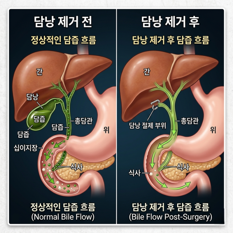 담낭염 수술 후 식단 7일 플랜! 회복 빠르게 하는 저지방 식단 완벽 가이드