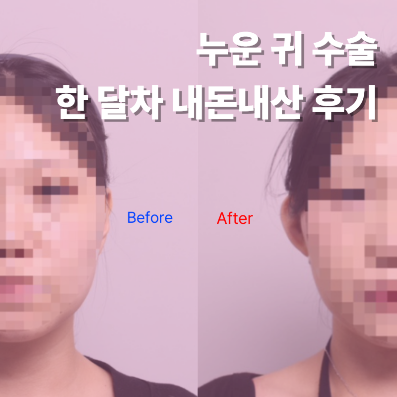 누운 귀 수술 내돈내산 한달 차 후기 | 수술 통증, 꿀팁