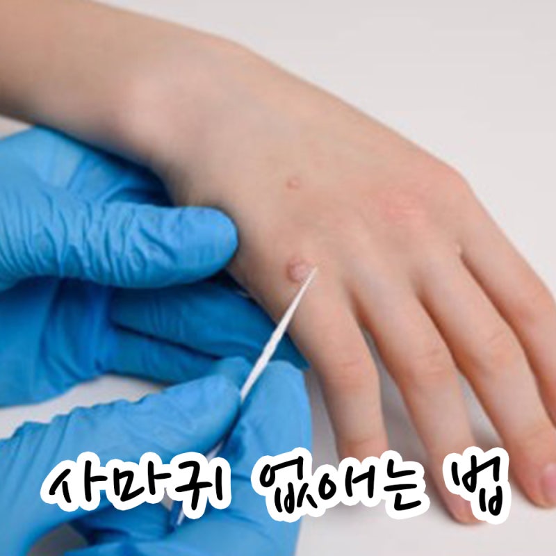 손가락 사마귀 뜯지 마세요, 원인 알고 없애는 방법