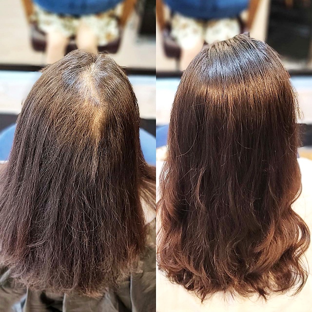  안산 가르마 갈라짐 고민, 가마 뒤쪽까지 연결된 휑한 빈틈 링거펌으로 채워질까요?
