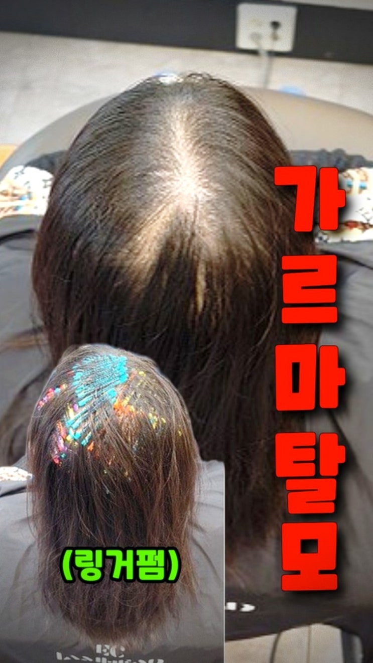  서울 마포구 연남동에서 찾아온 30대 여성 가르마 탈모, 수원 율전동 아엠헤드 모류교정 링거펌 후기