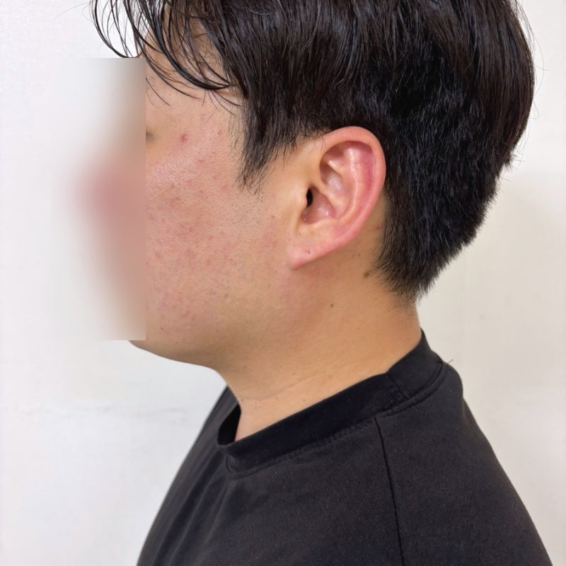 부천 신중동역 편평사마귀 제거 무제한 전후사진 비교 솔직후기(시술직후 ~ 일주일)
