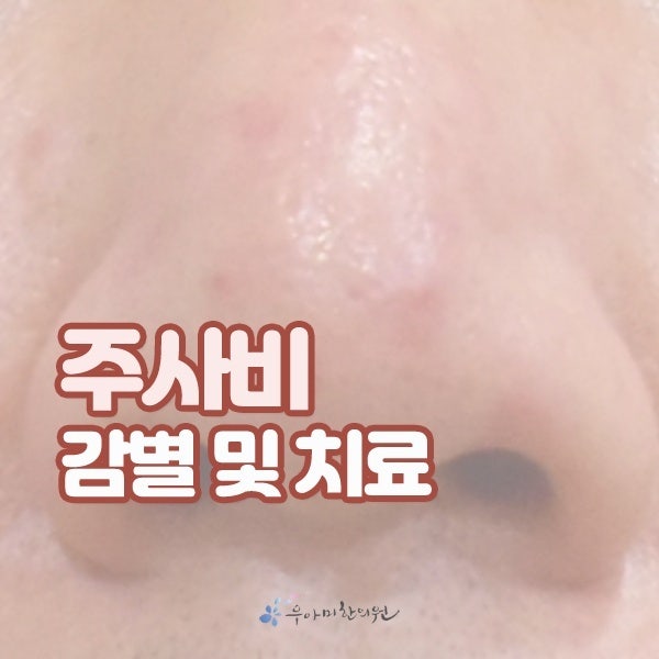 딸기코 치료, 크림써도 효과 없다면 방향을 바꿔야합니다.