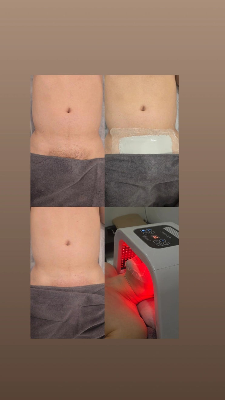  남자 브라질리언 왁싱, 진정케어 풀세트 무료에 4월 이벤트까지, 영등포 왁싱샵 "청춘케어"