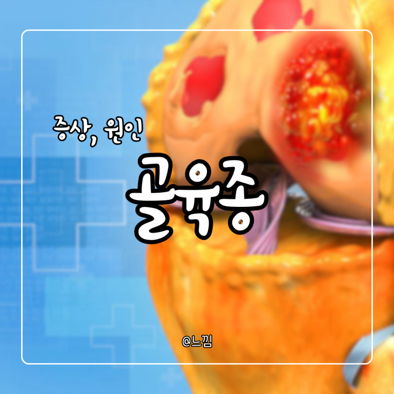 골육종 증상 원인 재발 골육종암 전이 완치율