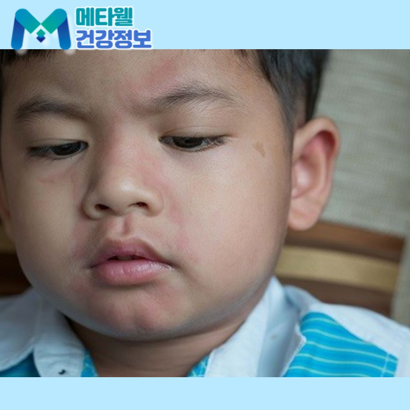 아이 뺨이 부었다면 볼거리일 수 있습니다! 증상과 병원 방문 기준