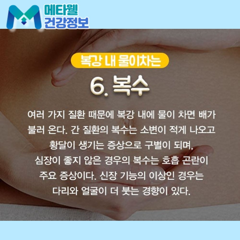 배가 풍선처럼 부풀어 오른다면? 복수 차는 증상과 원인 정리