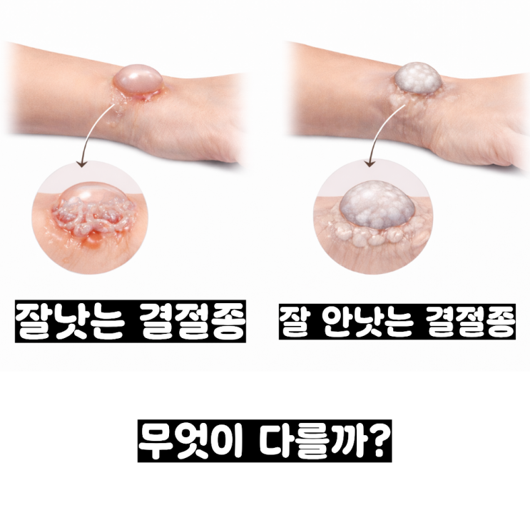  손목 결절종, 혹 생겼다고 무조건 수술받아야 할까요? 한의원 도침치료로 잘 낫습니다