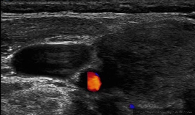 목 통증으로 내원한 환자 Subacute thyroiditis (아급성 갑상선염)