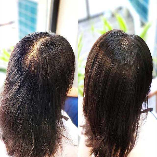  광명 가르마 갈라짐 고민, 가마 뒤쪽까지 연결된 휑한 정수리도 링거펌으로 채워질까요?