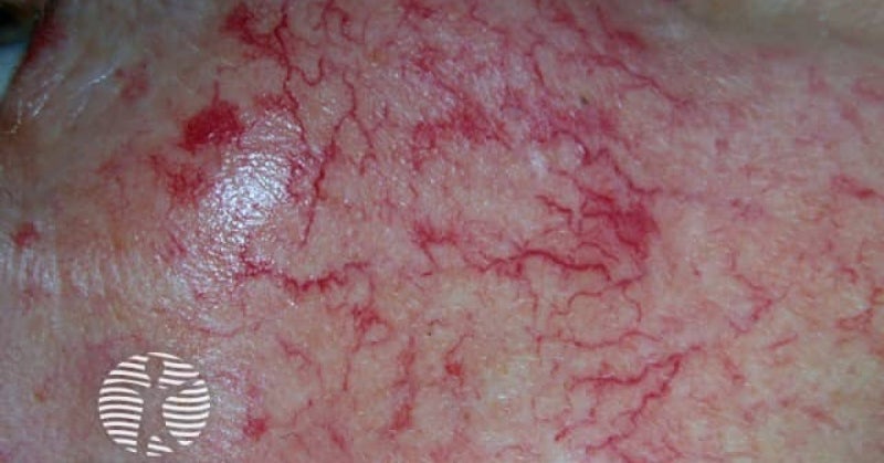 모세혈관확장증 Telangiectasia 뜻, 발음