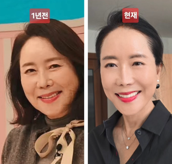 [뷰티] 안면거상술 후 윤영미 느낀 무력감? 해결해 줄 '먹는 보양 리프팅'