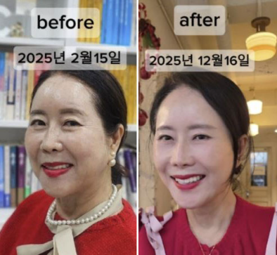 [뷰티] 윤영미 아나운서처럼 리즈 갱신! 수술 후 부기 쏙 빼는 식단 3가지