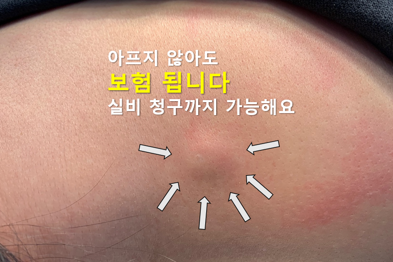 피지낭종 제거 보험 방문 전 약관 확인은 필수!