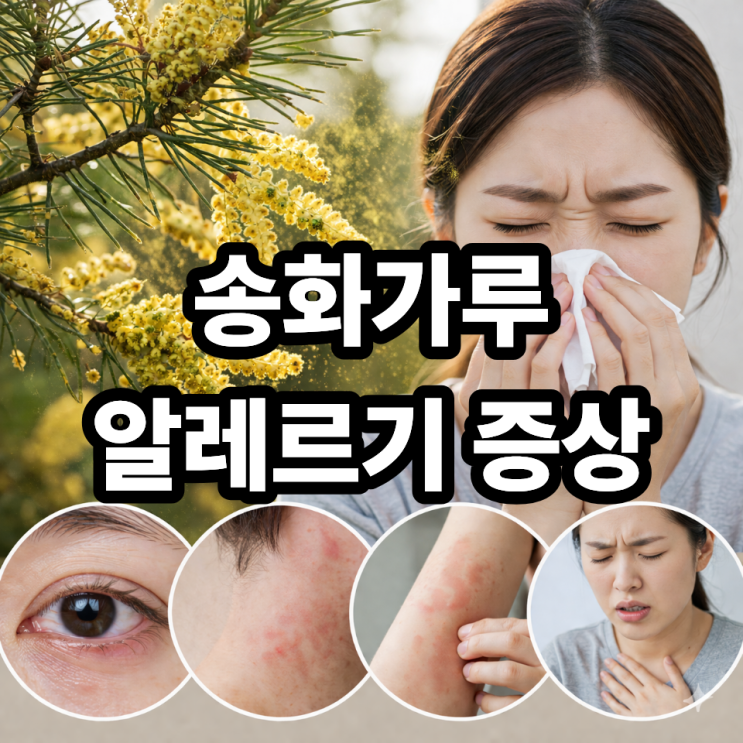  송화가루 알레르기 증상 총정리  봄철 비염·눈 가려움 원인 한눈에