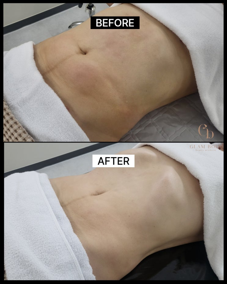  바본관리 고주파, 왜 필요할까? 지방흡입 후 단단함 완화 원리 정리
