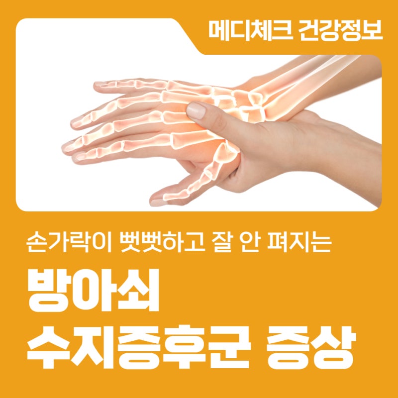 손가락이 뻣뻣하고 잘 안 펴지는 방아쇠수지증후군 증상