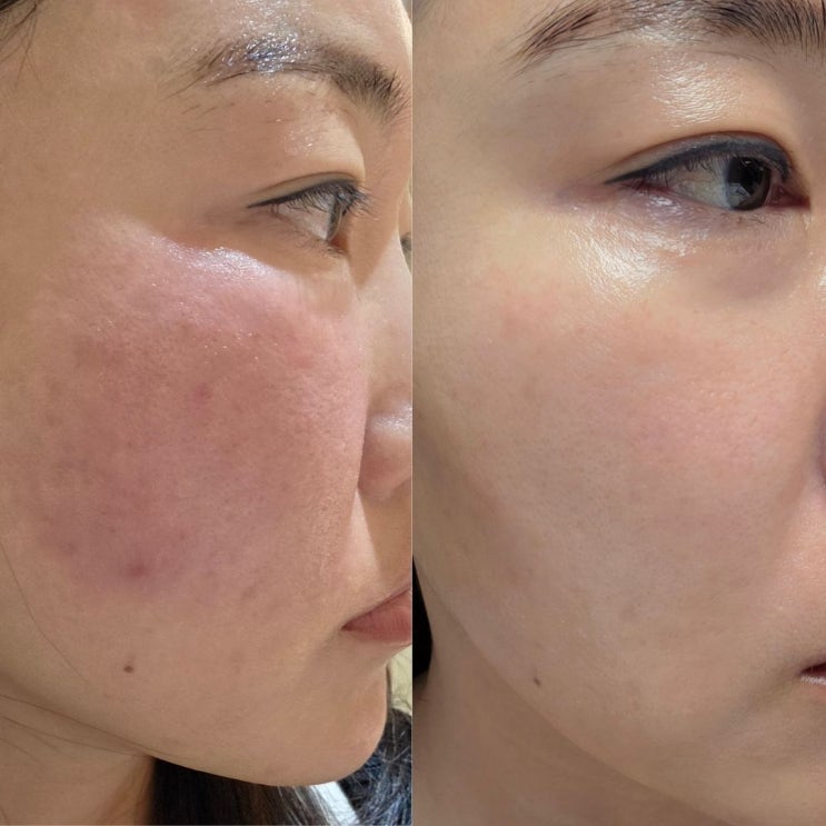  모공 관리 포텐자 + 쥬베룩 3차 전후(내돈내산) 피부과 시술 후 관리 장벽크림 추천