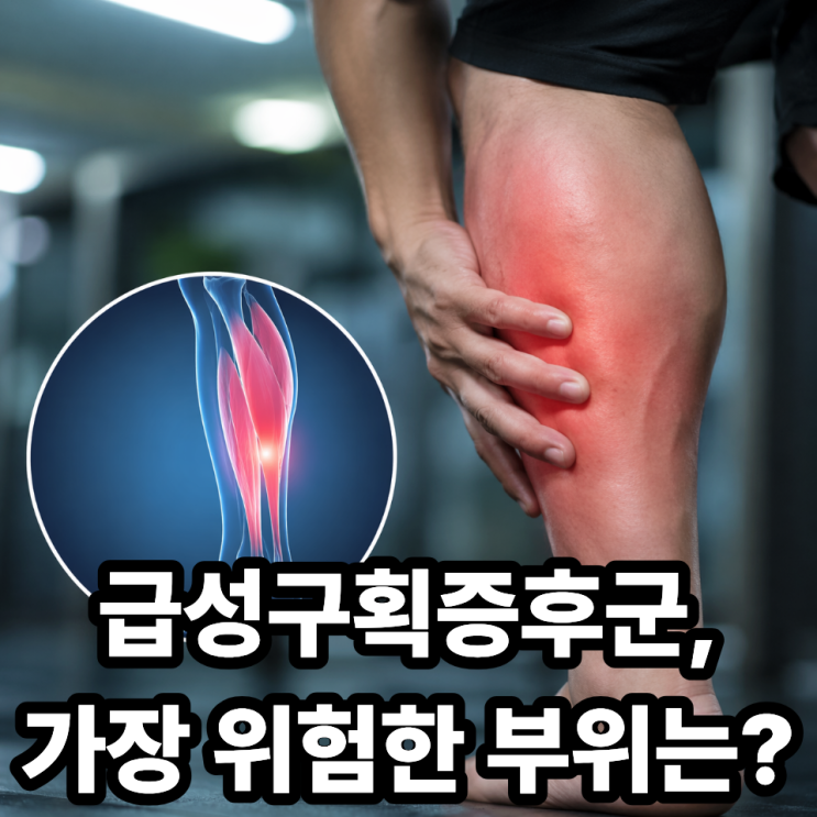  급성구획증후군 통증 위치, 어디가 가장 위험할까? 초기증상부터 위험 신호까지