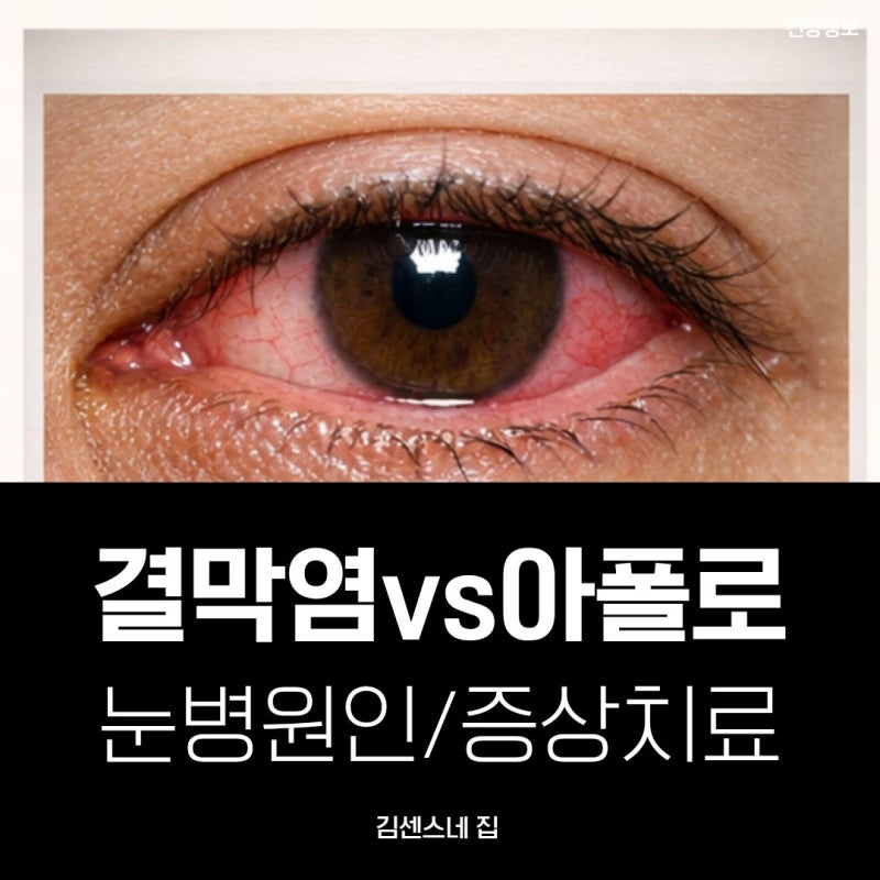 봄철 눈병 증상: 유행성 결막염, 아폴로 원인 및 치료(예방)